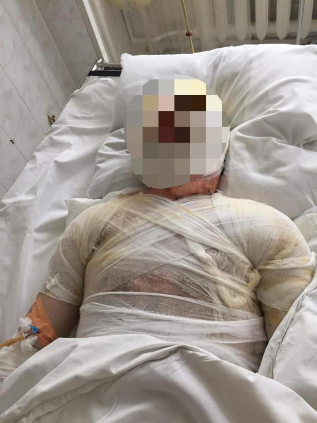 Майже все тіло в опіках: юнак, який взявся руками за електропровід на Рівненщині, у важкому стані