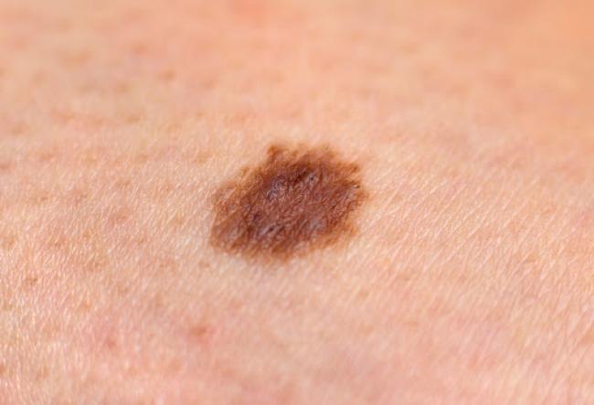 Що треба знати про меланому та як уберегтися від раку шкіри