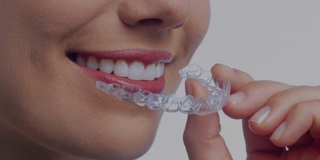 Капи для вирівнювання зубів: ефективність та шкода